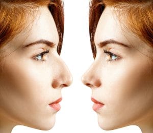 عمل بینی استخوانی در مشهد