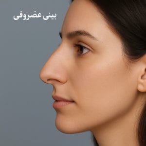 بینی غضروفی