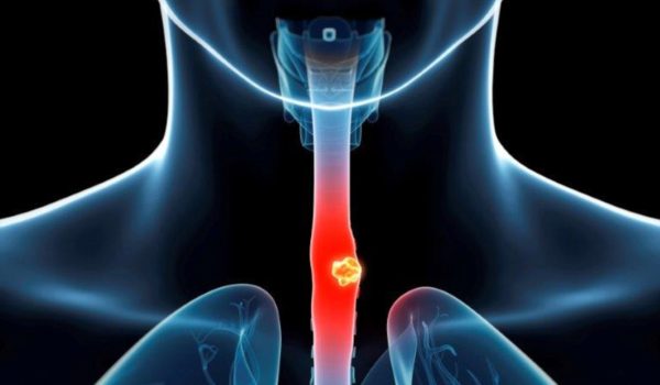 گیر کردن وسیله در گلو