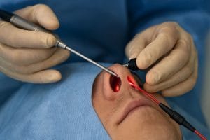 عمل پولیپ بینی با لیزر در مشهد