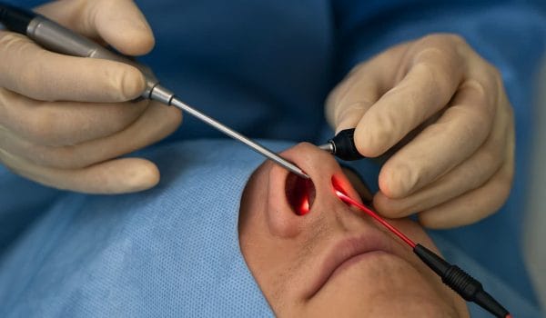 عمل پولیپ بینی با لیزر در مشهد