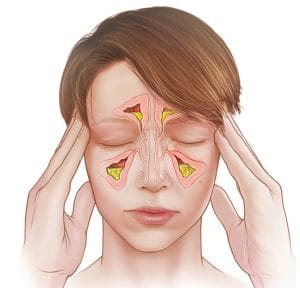 درمان سینوزیت مزمن