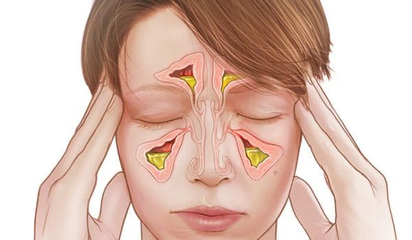 درمان سینوزیت مزمن