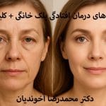 روش های درمان افتادگی پلک بدون جراحی