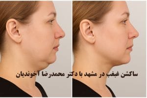 ساکشن غبغب در مشهد