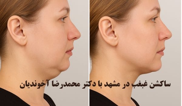 ساکشن غبغب در مشهد