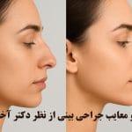 مزایا و معایب جراحی بینی