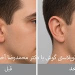 هزینه اتوپلاستی گوش در مشهد