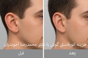 هزینه اتوپلاستی گوش در مشهد