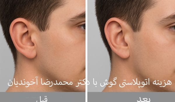 هزینه اتوپلاستی گوش در مشهد