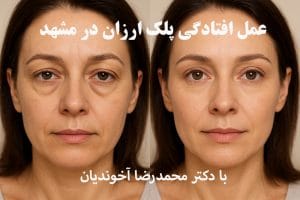 جراحی پلک ارزان در مشهد