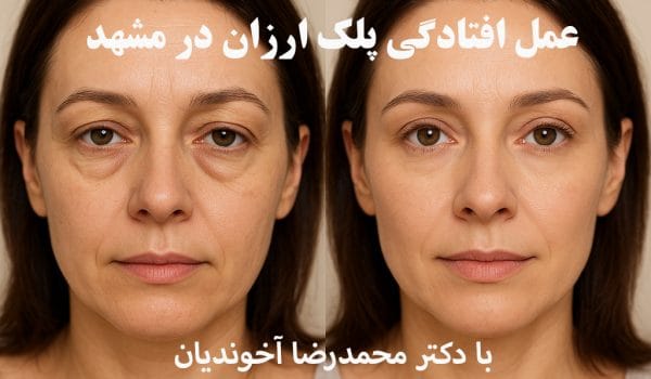 جراحی پلک ارزان در مشهد
