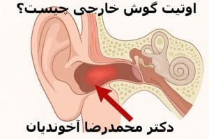 اوتیت گوش خارجی چیست؟