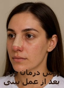 روش درمان ورم بعد از عمل بینی