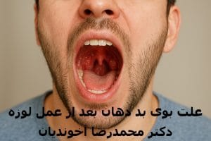 علت بوی بد دهان بعد از عمل لوزه