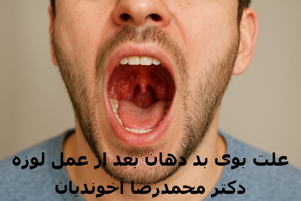 علت بوی بد دهان بعد از عمل لوزه