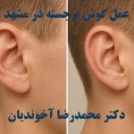 عمل گوش برجسته در مشهد
