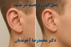 عمل گوش برجسته در مشهد