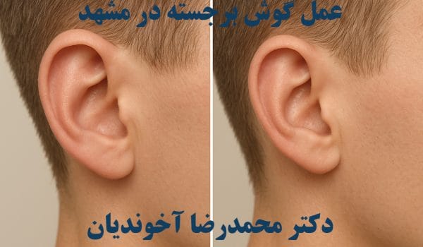 عمل گوش برجسته در مشهد