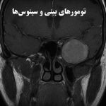 تومورهای بینی و سینوس‌ها