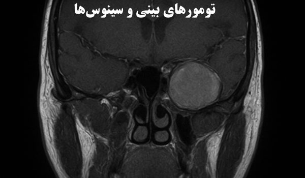 تومورهای بینی و سینوس‌ها