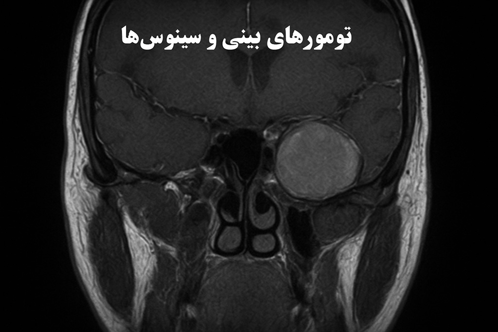 تومورهای بینی و سینوس‌ها