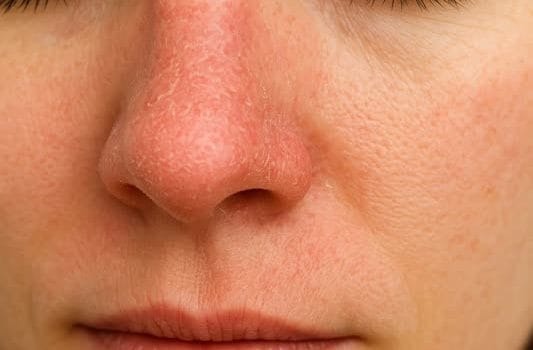 خشکی بینی؛ علتها، علائم و روشهای درمان مؤثر