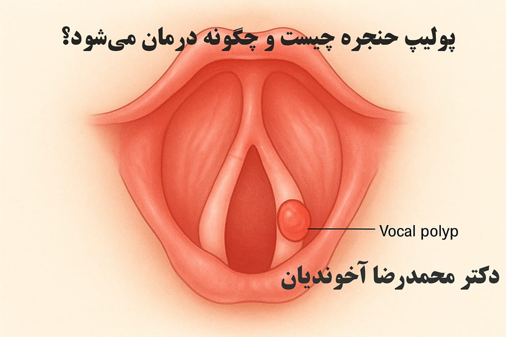 پولیپ حنجره چیست و چگونه درمان می‌شود؟