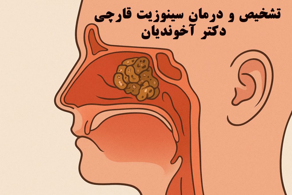تشخیص و درمان سینوزیت قارچی - دکتر آخوندیان