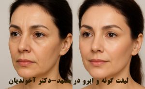 لیفت گونه و ابرو در مشهد-دکتر آخوندیان