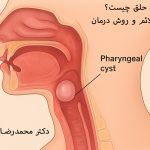 کیست حلق چیست؟ علل و علائم و روش درمان