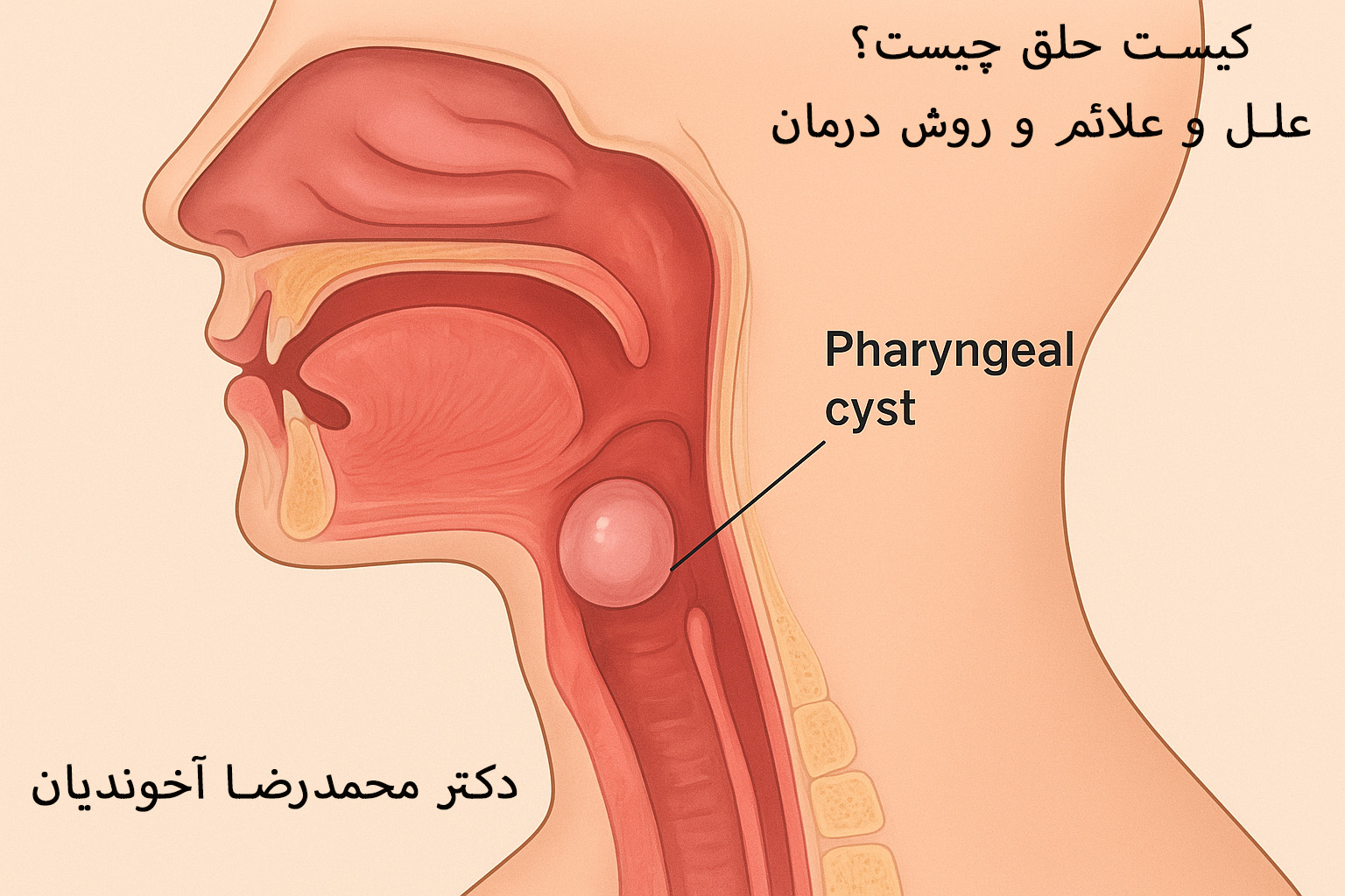 کیست حلق چیست؟ علل و علائم و روش درمان