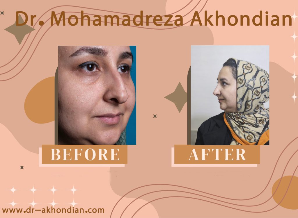 جراحی بینی 1