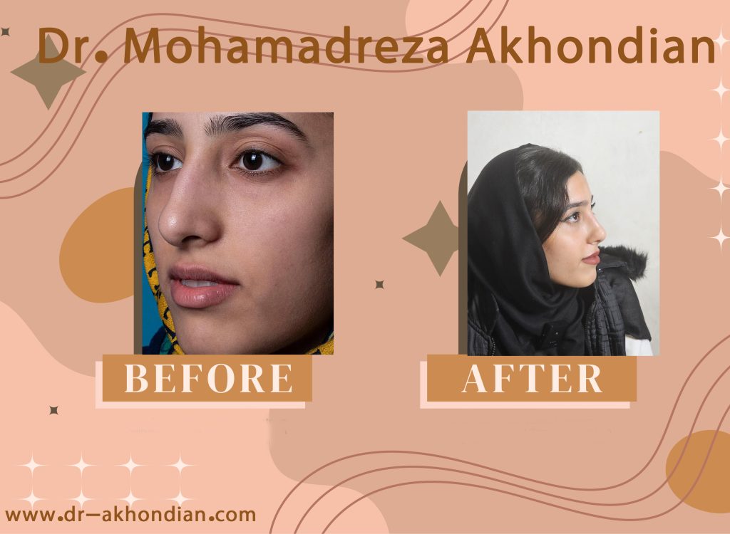 جراحی بینی 2