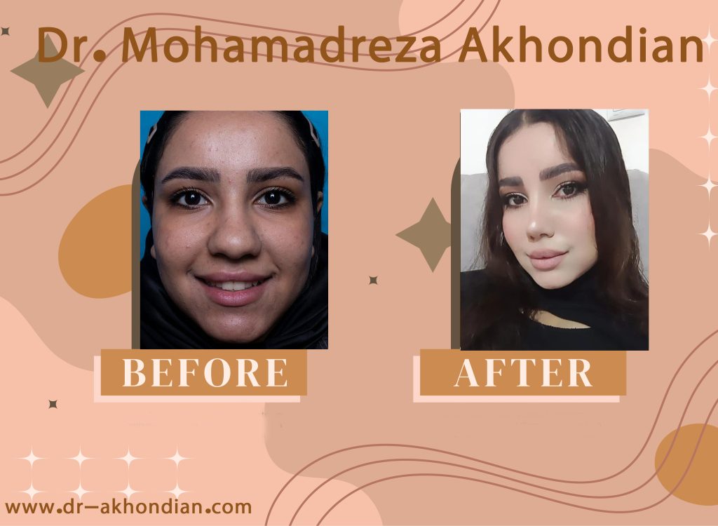 جراحی بینی 3