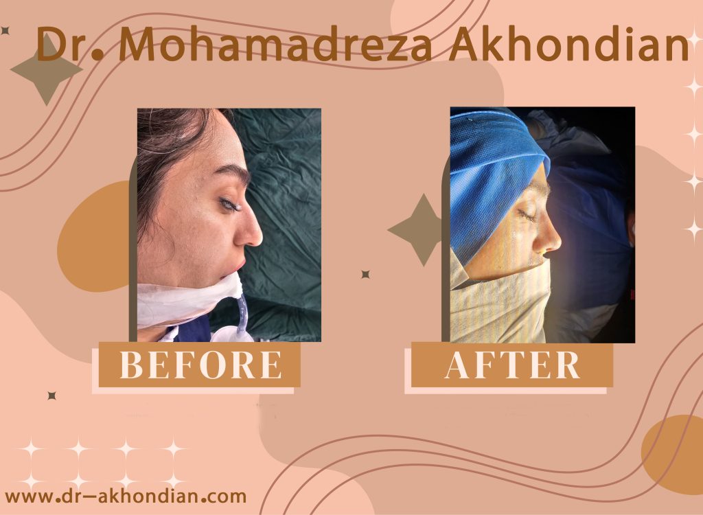 جراحی بینی 4