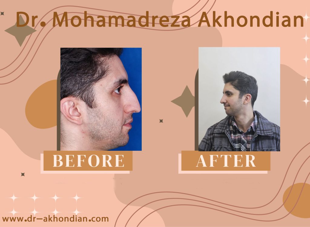 جراحی بینی 6