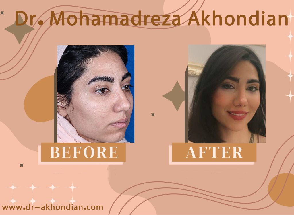 جراحی بینی 7