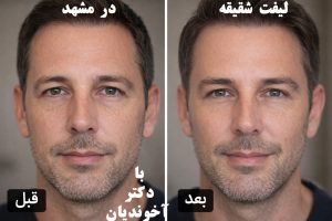 لیفت شقیقه در مشهد