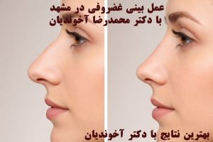 عمل بینی غضروفی در مشهد